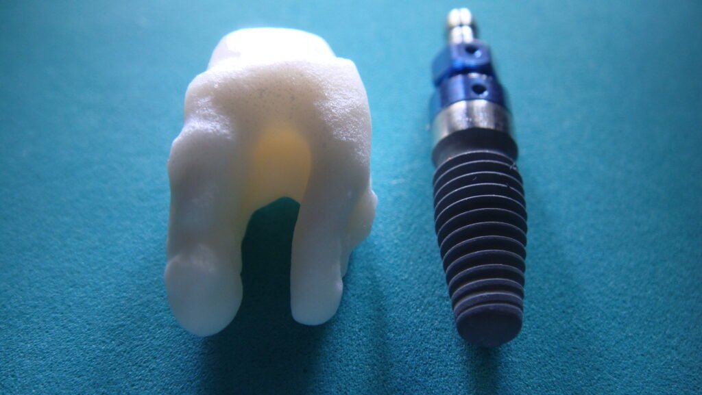 File:Root analogue ceramic dental implant vs titanium screw type implant.jpg